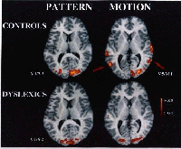 MRI comparison scans